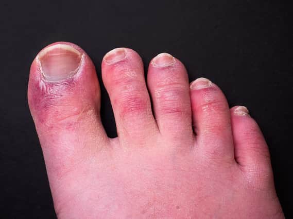 The symptoms of Covid toes include chilblain-like inflammation and redness on the hands and feet (Photo: Shutterstock)