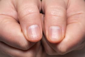 'Beau's lines' are transverse indents in the nail (Photo: Shutterstock)