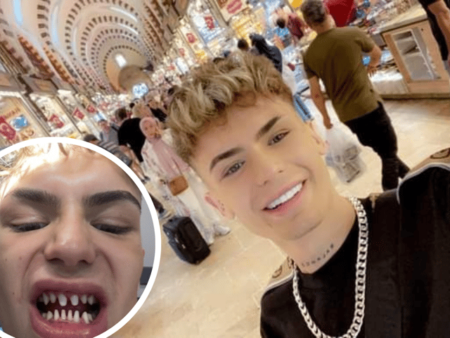  ‘Turkey teeth’ warning as horror surgery left Manchester model ‘looking like a shark’