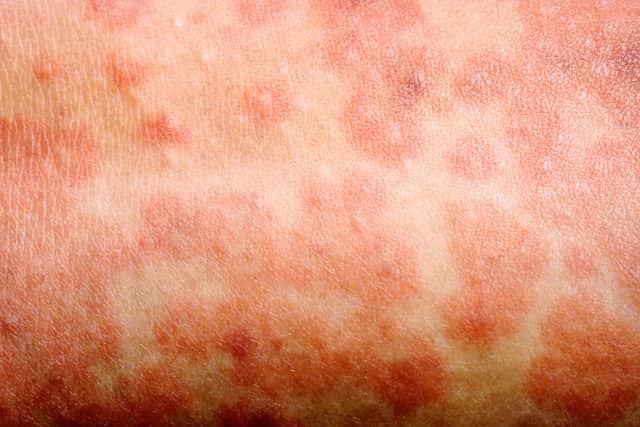 The spots of the measles rash are sometimes raised and join together to form blotchy patches.