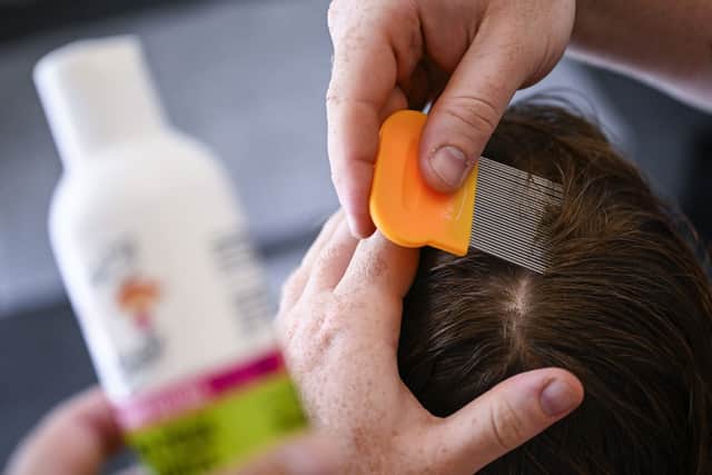 This year has seen an unusual spike in head lice cases. (Photo: LAURIE DIEFFEMBACQ/BELGA MAG/AFP via Getty Images)