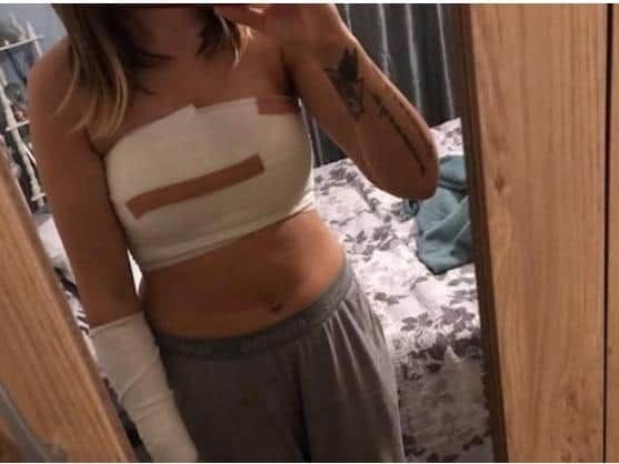 Stacey Andrew shows her burns