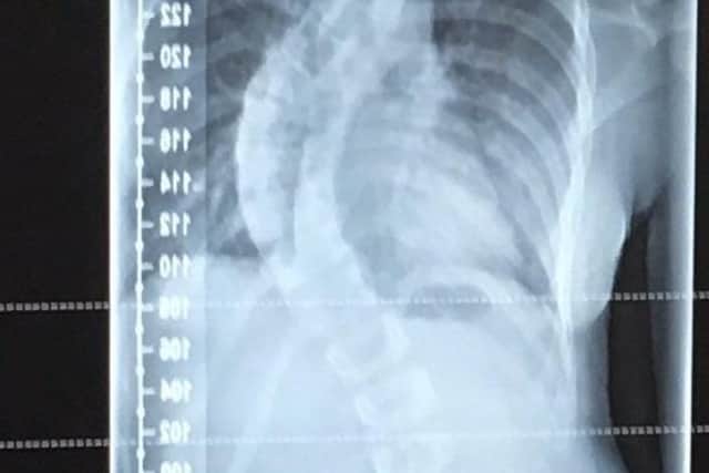 An x-ray of Chantelle's spine before her surgery.