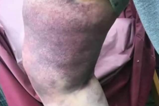 Dorothy Butterworth suffered a torn ligament and extensive bruising during the attack.