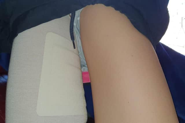 Helena Greetham's leg was impaled by her board while surfing at Sandilands.