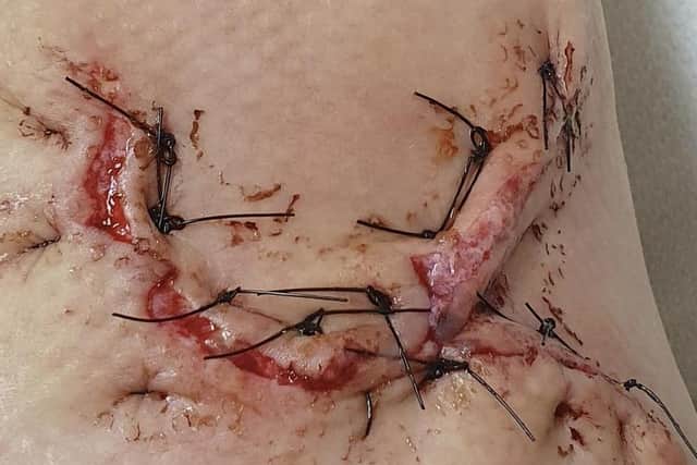 The injury needed 27 stitches.