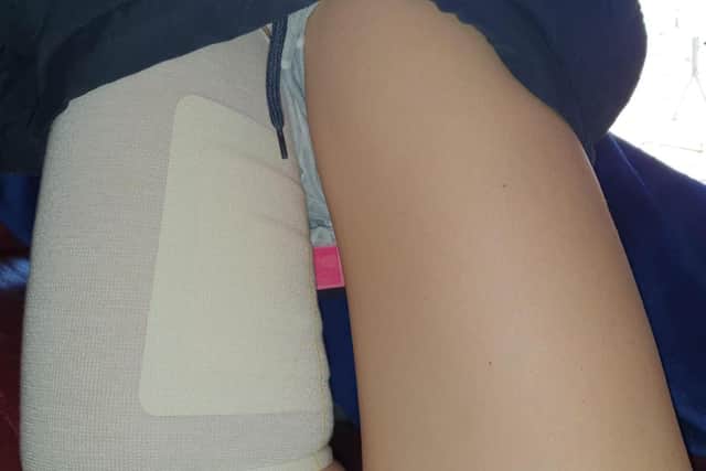 Helena Greetham's leg was impaled by her board while surfing at Sandilands.