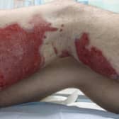 Connor Degnan's burnt leg  EMN-200806-141202001