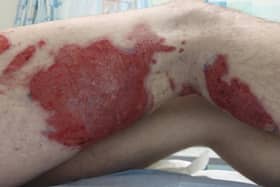 Connor Degnan's burnt leg  EMN-200806-141202001