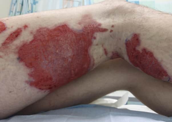 Connor Degnan's burnt leg EMN-200806-141202001
