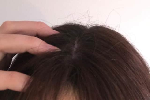 Head lice can make your head feel itchy