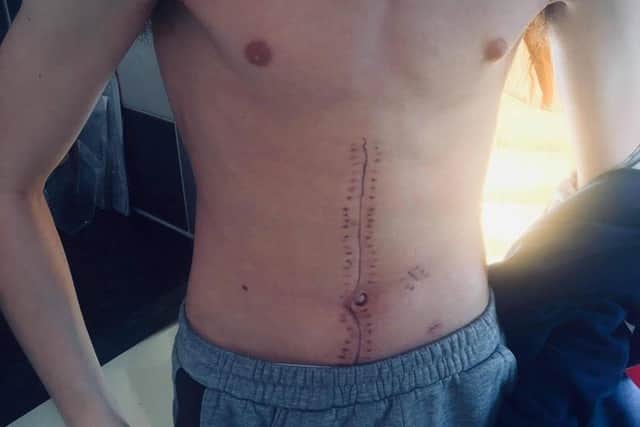 Liam has been left with 30cm scar after his six-hour life-saving operation following being stabbed.