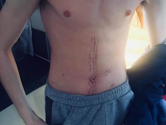 Liam has been left with 30cm scar after his six-hour life-saving operation following being stabbed.