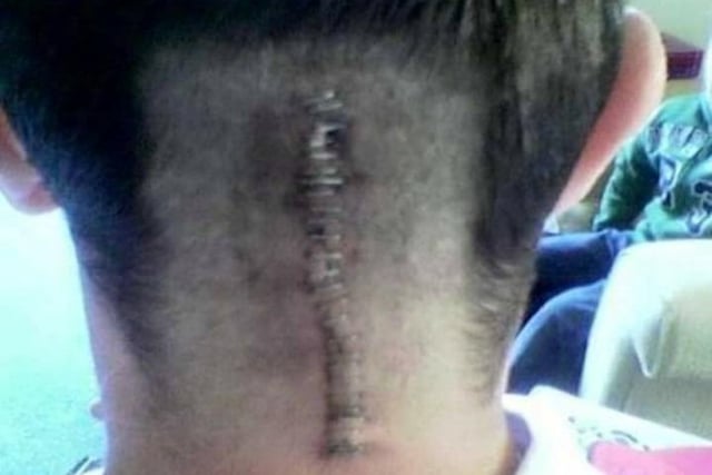 Wayne Chessum’s surgery scar.