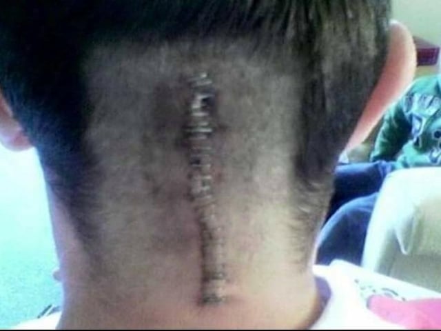 Wayne Chessum’s surgery scar.