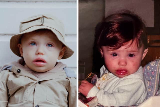 Danni as a baby. Like Clay, she has also suffered with symptoms of STAT1 gain-of-function since infancy - but wasn't diagnosed until her mid-twenties.