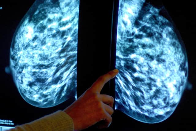 Generic stock picture of a mammogram showing a womans breast in order check for breast cancer at Derby City Hospital.