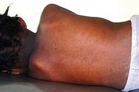 Measles advice - Photo: UKHSA