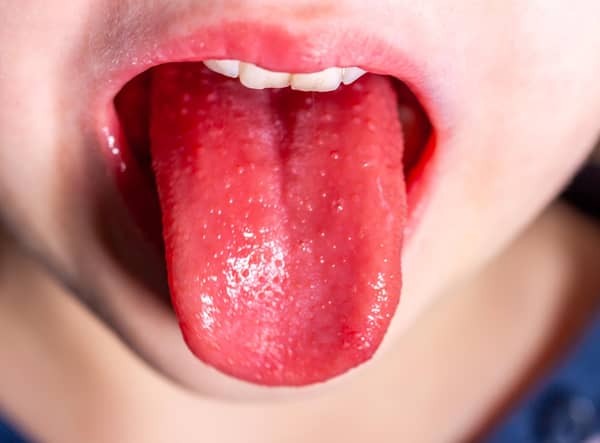 Tongue of a child with scarlet fever - strawberry tongue.