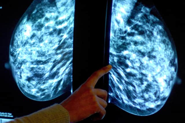Generic stock picture of a mammogram showing a womans breast in order check for breast cancer at Derby City Hospital.