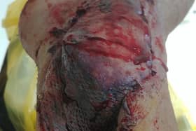 Debra's injury