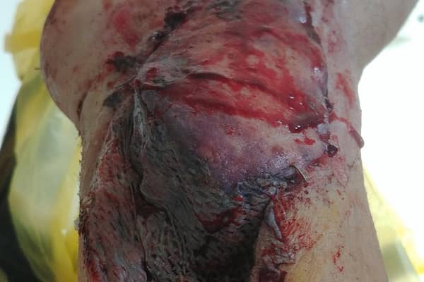 Debra's injury