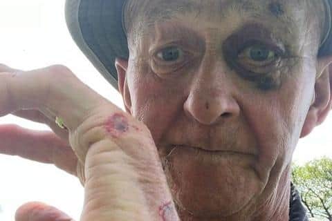 David's injuries after his fall on day four.