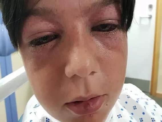 He was left with bulging eyes after the incident