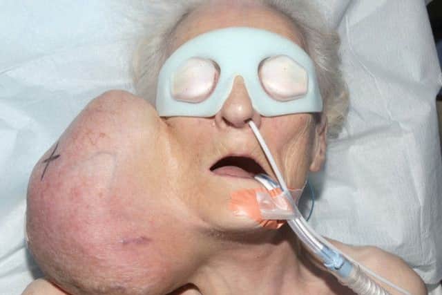 Joyce Haigh, 79, pictured before the 2kg tumour was removed.