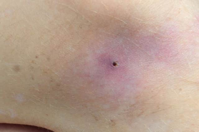 A spider bite.
