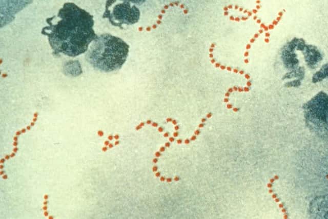 Scarlet fever.