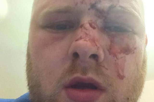 Carl Benham lost his eye in a glassing at the Marine Boathouse in Skegness.by ANL-180105-090854001