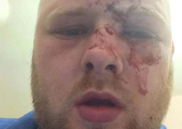 Carl Benham lost his eye in a glassing at the Marine Boathouse in Skegness.by ANL-180105-090854001