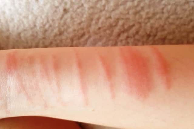 RNLI lifeguards are warning beach-goers to take extra care with jellyfish and weeverfish this summer, as their presence increases in warmer weather. A girl from Mablethorpe was recently stung badly by a jellyfish. Photo: Supplied image.