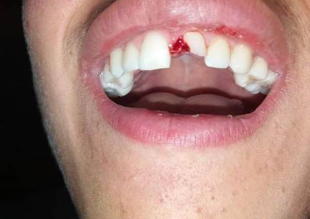 A teenagers tooth was damaged in an incident involving a BB gun. ANL-180110-123259001
