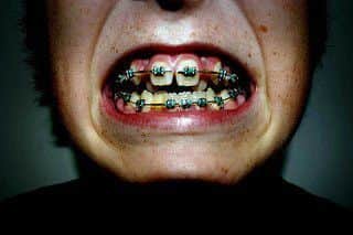 A survey on  Orthodontic treatment, which often involves fitting braces, is taking place across NHS Englands Central Midlands area ANL-181026-091218001