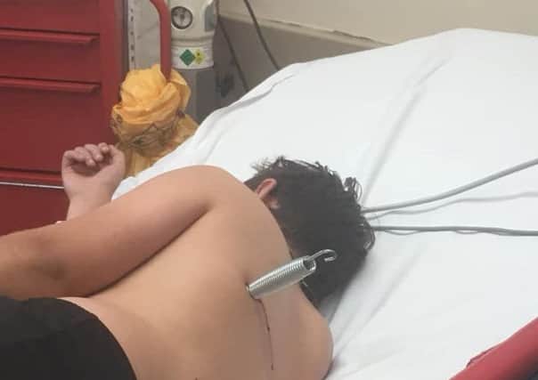 Jamie Quinlan (12), pictured with the metal spring embedded six centimetres into his back.