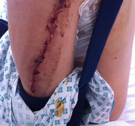 Kate Hunter after the accident in The Royal National Orthopaedic Hospital, Stanmore, London.