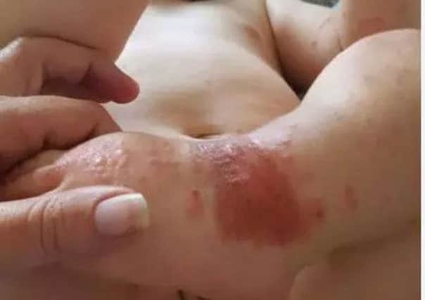 Amy Stinton took this picture of her 14-month-old son Oliver after he contracted the herpes simplex virus and came out in blisters