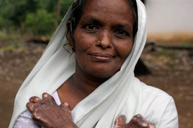 Leprosy colony resident Laxmi.