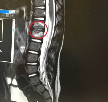 An x-ray of Teddie's spine, with the infected area circled in red.