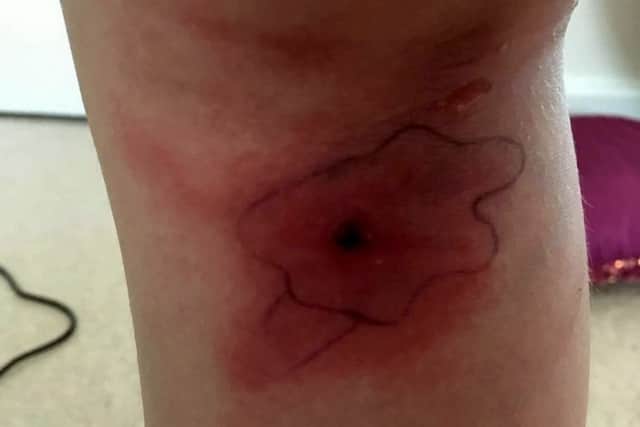 Scarlett Hinchliffe's insect bite - after a 'spider' crawled out. Photo: SWNS EMN-170517-112820001